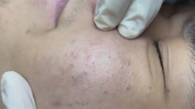 064  Acne collection  АСМР  Relax Spa