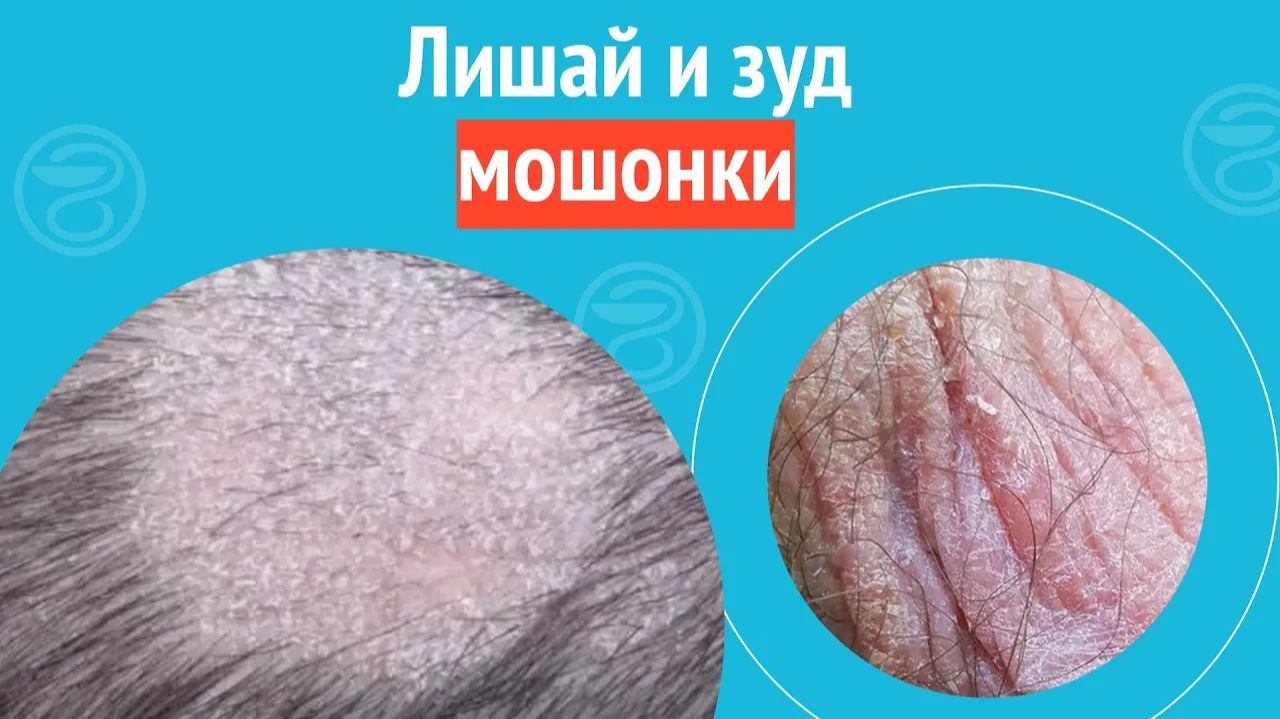 🙄 Лишай и зуд мошонки. Клинический случай №1351