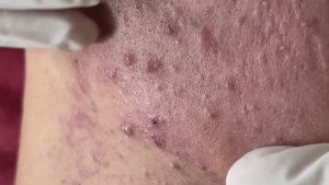 Вскрытие гигантских кистозных акне Часть 1