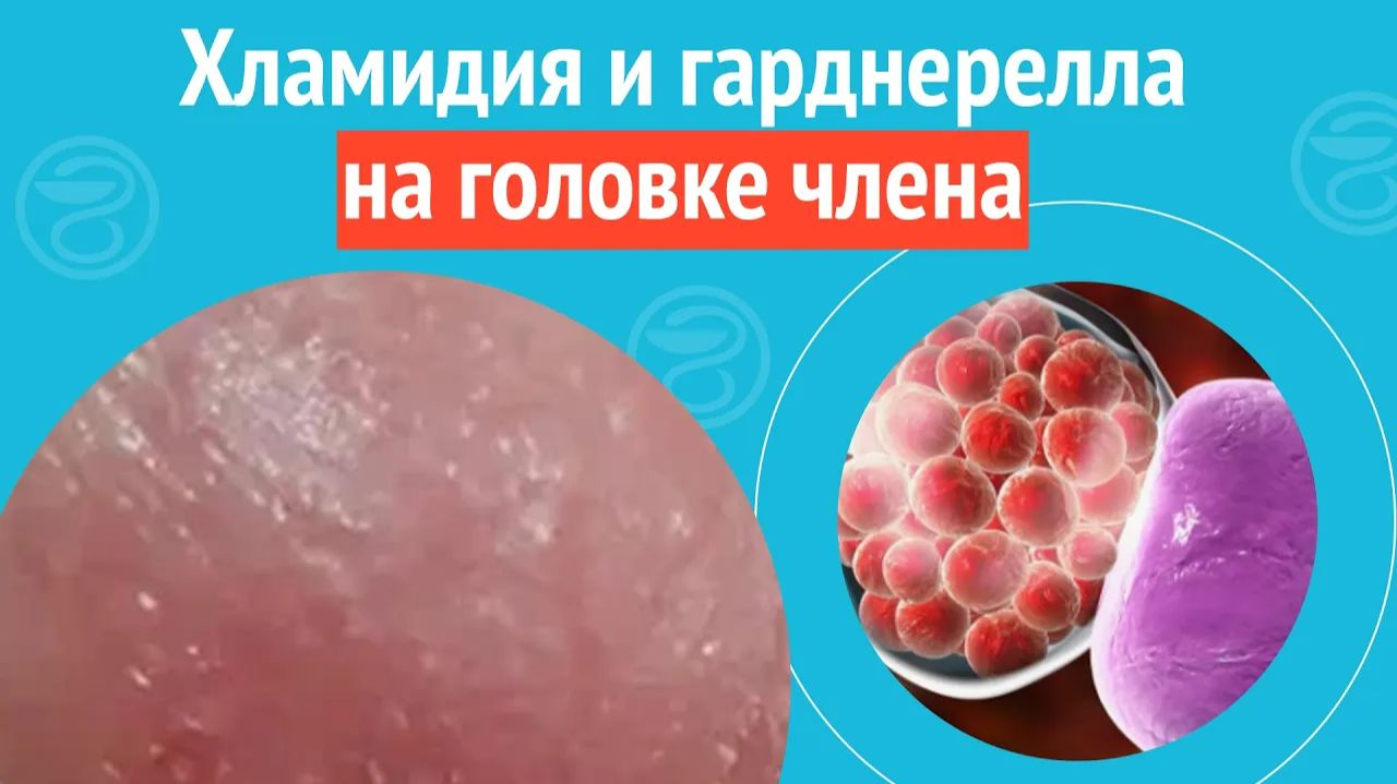 🥹 Хламидия и гарднерелла на головке члена. Клинический случай №1338 смотреть онлайн