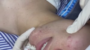 063 • Acne collection • АСМР • Relax Spa