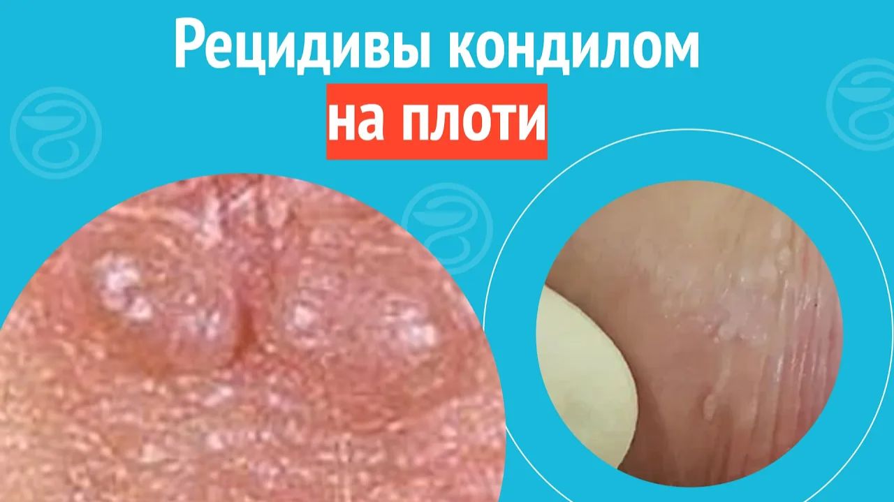 😮 Рецидивы кондилом на плоти. Клинический случай №1345 смотреть онлайн