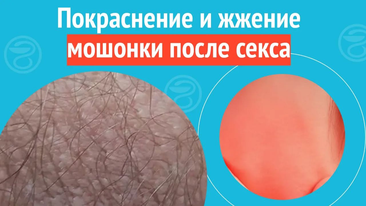 ↪️ Покраснение и жжение мошонки после секса. Клинический случай №1332 смотреть онлайн