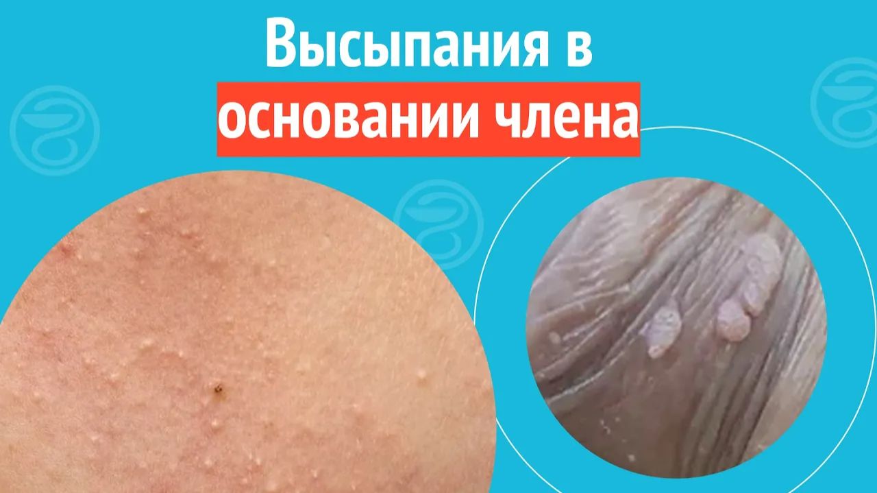 ↪️ Высыпания в основании члена. Клинический случай №1349 смотреть онлайн