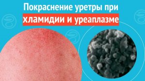 😦 Покраснение уретры при хламидии и уреаплазме. Клинический случай №1371