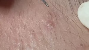 Удаление черных точек и акне с минимальной травмой