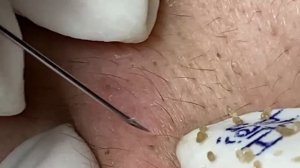 Экстракция черных точек и акне