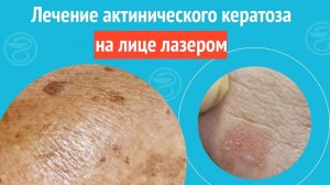 ✅ Лечение актинического кератоза на лице лазером. Клинический случай №1362