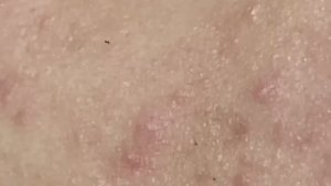 Механическая экстракция черных точек и акне