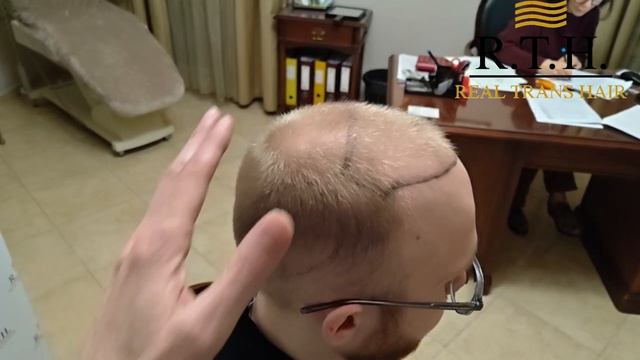 Алопеция у молодых мужчин: особый подход к пересадке волос