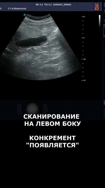 Полипозиционное сканирование желчного пузыря