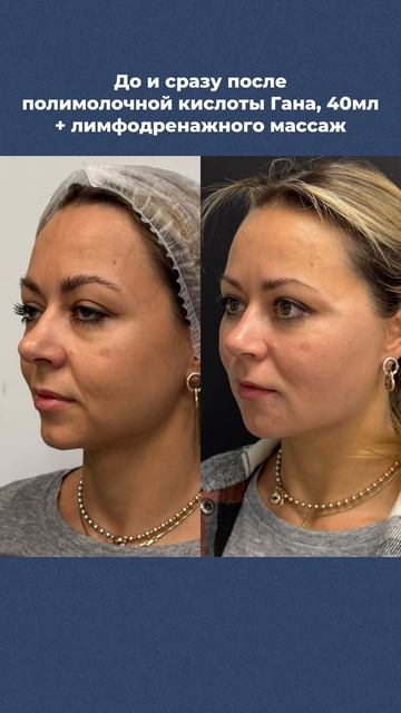 Процедура ПОЛИМОЛОЧНОЙ кислоты