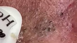 #244 Чистка лица от угрей и акне. Выдавливание прыщей. Удаление черных точек и комедонов