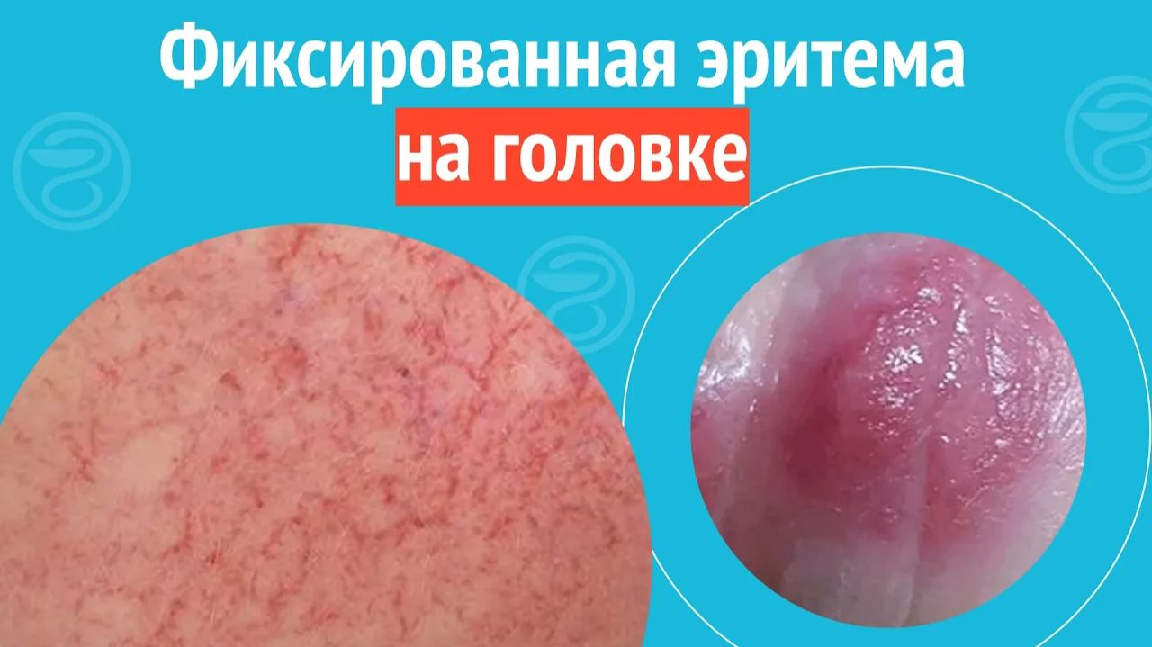 🥺 Фиксированная эритема на головке. Клинический случай №1361 смотреть онлайн