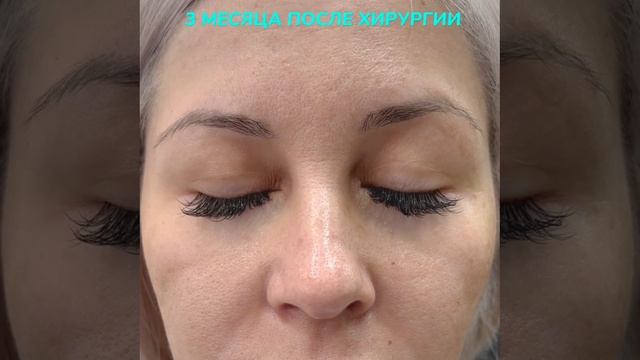 3 месяца после операции жиросохраняющая нижняя блефаропластика