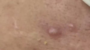 Экстракция всего лица: черные точки + акне