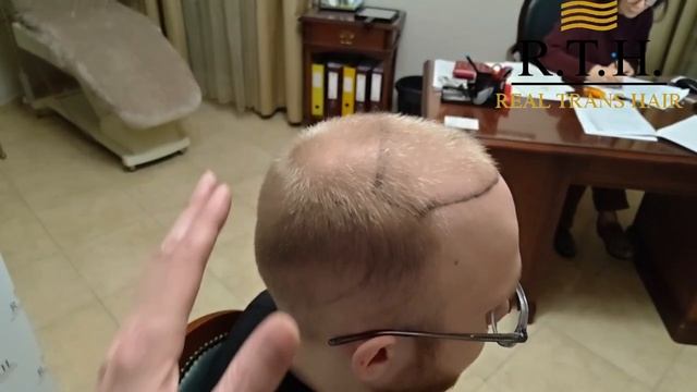 Алопеция у молодых мужчин: особый подход к пересадке волос