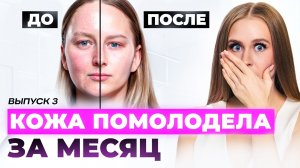 Убрали подкожники и первые морщины ЗА 1 МЕСЯЦ! Как ухаживать за кожей дома, чтобы стареть медленнее