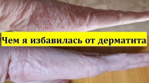 Чем я избавилась от дерматита.