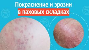 😧 Покраснение и эрозии в паховых складках.  Клинический случай №1366