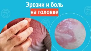 😦 Эрозии и боль на головке. Клинический случай №1359