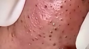 #245 Чистка лица от угрей и акне. Выдавливание прыщей. Удаление черных точек и комедонов