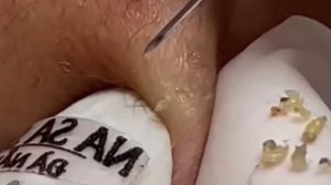 #246 Чистка лица от угрей и акне. Выдавливание прыщей. Удаление черных точек и комедонов