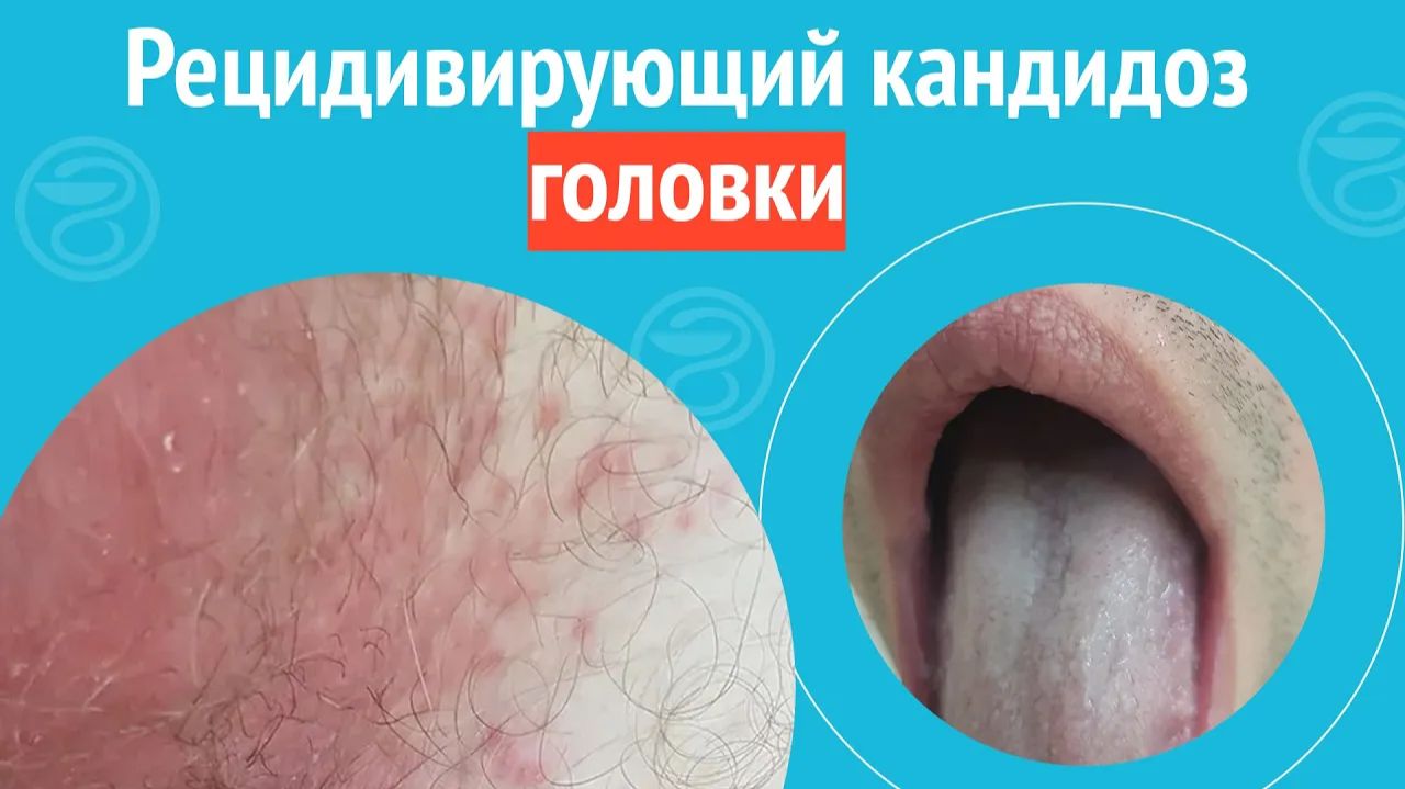 😨 Рецидивирующий кандидоз головки. Клинический случай №1363 смотреть онлайн