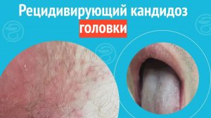 😨 Рецидивирующий кандидоз головки. Клинический случай №1363