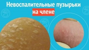 😐 Невоспалительные пузырьки на члене. Клинический случай №1369