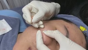 Удаление черных точек и акне без цензуры