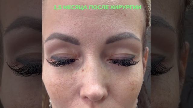 1,5 месяца после операции нижняя блефаропластика