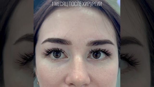 1 месяц после операции нижняя блефаропластика