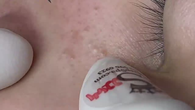 068  Acne collection  АСМР  Relax Spa