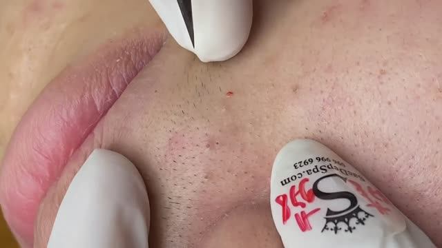 067 • Acne Collection • АСМР • Relax Spa