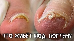 ТАКОЕ под ногтем из-за обуви 🤯
