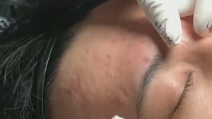 Удаление черных точек и акне в условиях салона