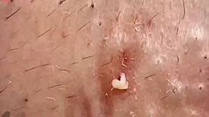 #247 Чистка лица от угрей и акне. Выдавливание прыщей. Удаление черных точек и комедонов