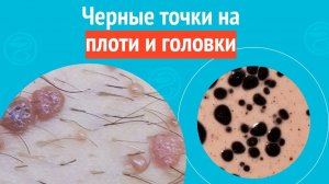 🥺 Черные точки на кондиломах лобка. Клинический случай № 1766