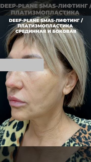 1 месяц после операции фейслифтинг