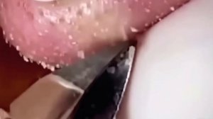 #248 Чистка лица от угрей и акне. Выдавливание прыщей. Удаление черных точек и комедонов