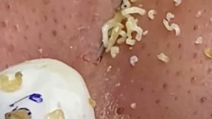 #249 Чистка лица от угрей и акне. Выдавливание прыщей. Удаление черных точек и комедонов