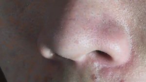 Удаление черных точек и акне — эстетический кайф