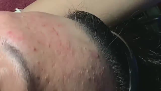 Комбинированная чистка: удаление комедонов + акне