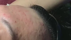 Комбинированная чистка: удаление комедонов + акне