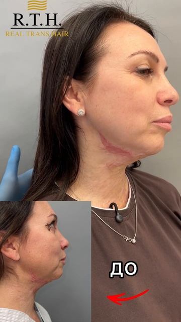 Блефаропластика. И пересадка кожи. Результат!