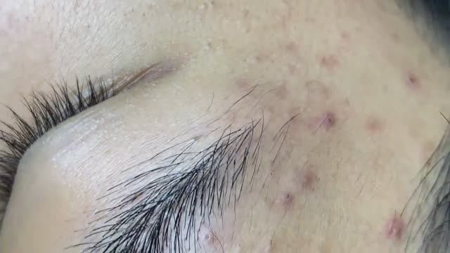 066 • Acne collection • АСМР • Relax Spa