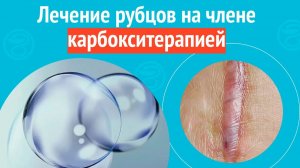 👉 Лечение рубцов на члене карбокситерапией. Клинический случай № 1769
