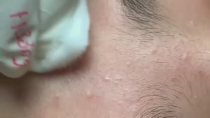 Удаление черных точек и акне — момент истины для пор