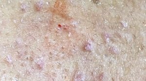 Выдавливание прыщей, угрей, черных точек и камедонов #344